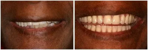 Before and after All-on-4 dental implants: Failing Upper Teeth Replaced at Clearbrook Advanced Dental Care in Cranbury, NJ