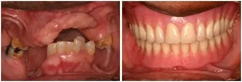 Before and after full mouth restoration: Worn Dentition Rebuilt at Clearbrook Advanced Dental Care in Cranbury, NJ