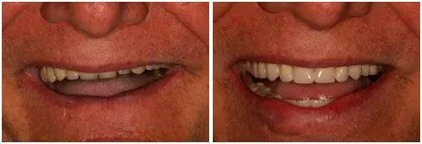 Before and after dental crown or bridge: Damaged Tooth Capped at Clearbrook Advanced Dental Care in Cranbury, NJ