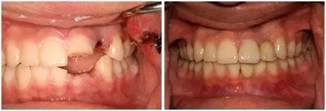 Before and after custom dentures: Full Smile Restored at Clearbrook Advanced Dental Care in Cranbury, NJ