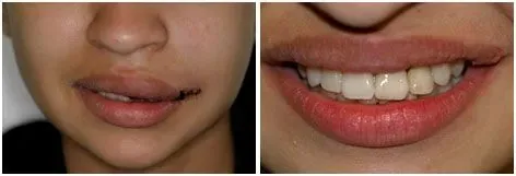 Before and after dental crown or bridge: Gap Closed with a Bridge at Clearbrook Advanced Dental Care in Cranbury, NJ