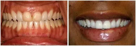 Before and after full mouth restoration: Function and Aesthetics Restored at Clearbrook Advanced Dental Care in Cranbury, NJ