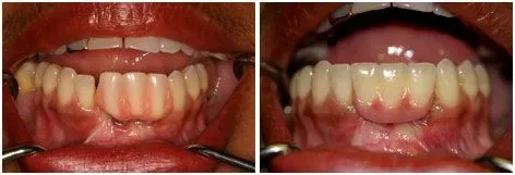 Before and after full mouth restoration: A Complete Smile Makeover at Clearbrook Advanced Dental Care in Cranbury, NJ