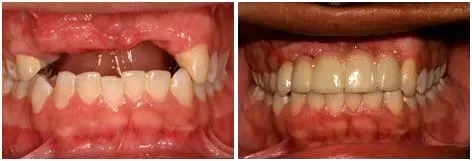 Before and after custom dentures: Stable, Confident Bite at Clearbrook Advanced Dental Care in Cranbury, NJ