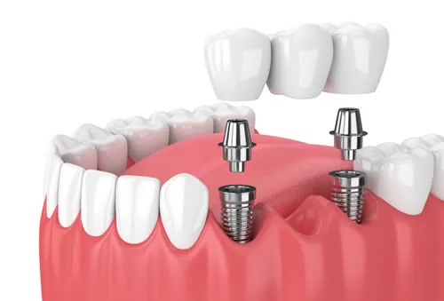 Implant-supported bridge replacing multiple adjacent missing teeth