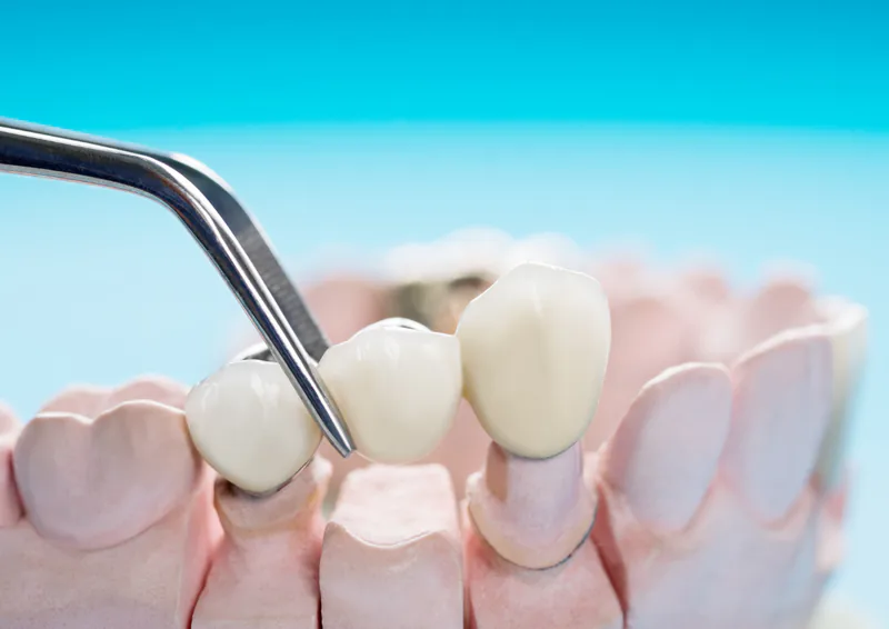 A three-unit dental bridge being placed onto prepared abutment teeth on a dental model at Clearbrook Advanced Dental Care in Cranbury, NJ